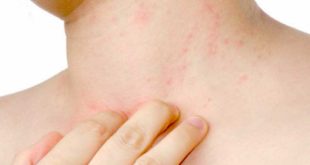 Irritazioni, pruriti, eczema. Come calmare la pelle con l'arrivo della primavera?